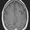 6A2 AVM (Case 6) T1 with contrast - Copy