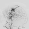 6A3 AVM (Case 6) angiogram - Copy