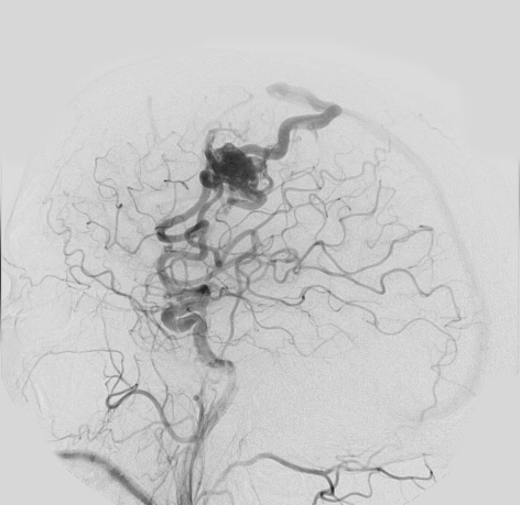 6A3 AVM (Case 6) angiogram - Copy