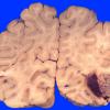 7A1 AVM (Case 7) & embolization 2