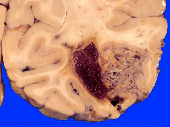 7A2 AVM (Case 7) & embolization 1