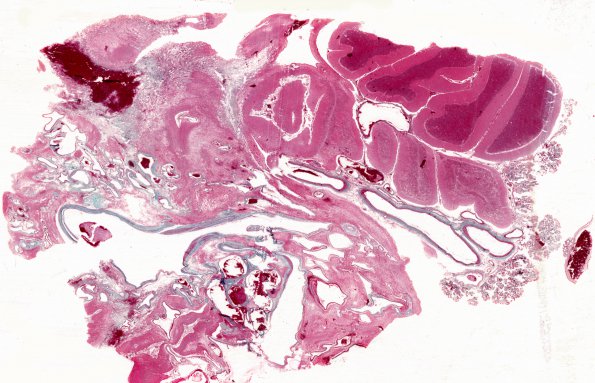 8C1 AVM (Case 8) Trichrome WM