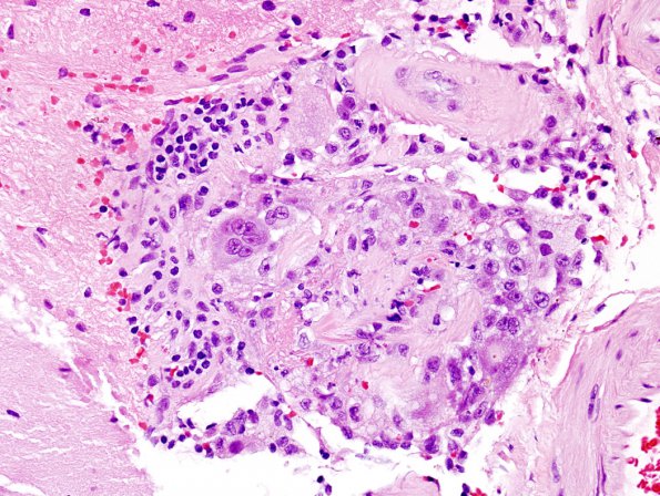 10A1 Congophilic Angiopathy-Vasculitits (Case 10)  1