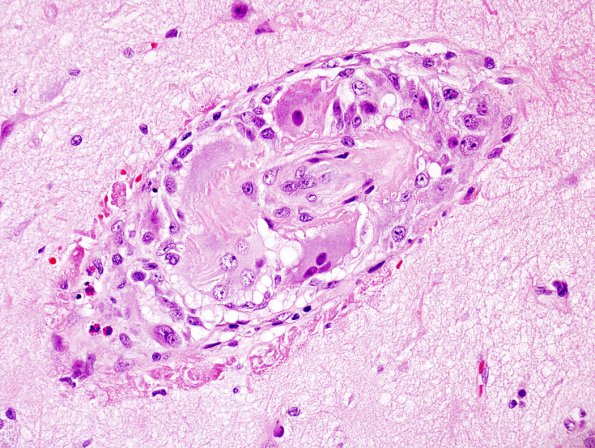 10A2 Congophilic Angiopathy-Vasculitits (Case 10)  4