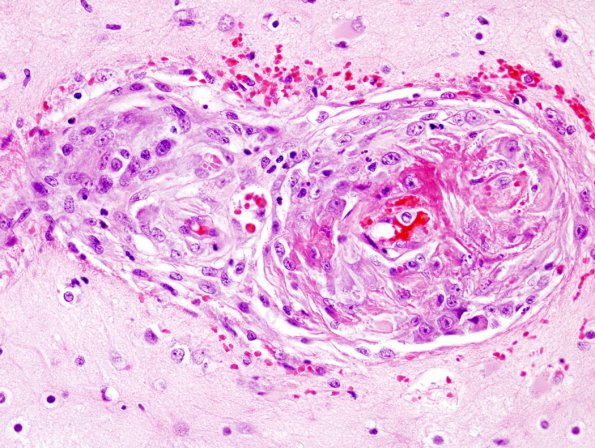 10A3 Congophilic Angiopathy-Vasculitits (Case 10)  7