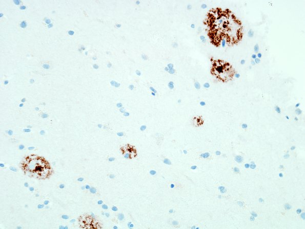 1B2 ABRA (Case 1) B-amyloid 1