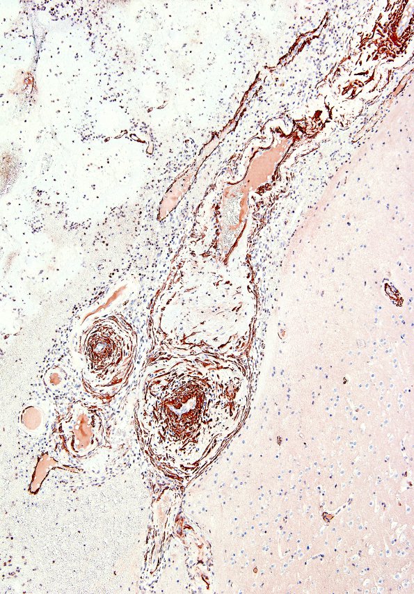 1E1 ABRA (Case 1) SMA 2