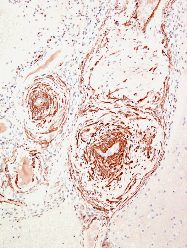 1E2 ABRA (Case 1) SMA 1