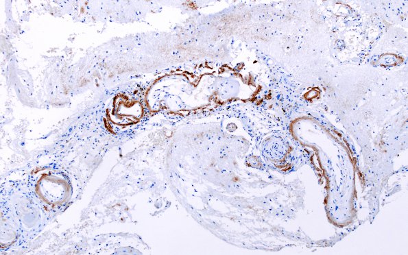 2B1 ABRA (Case 2) B-Amyloid 2 (2)