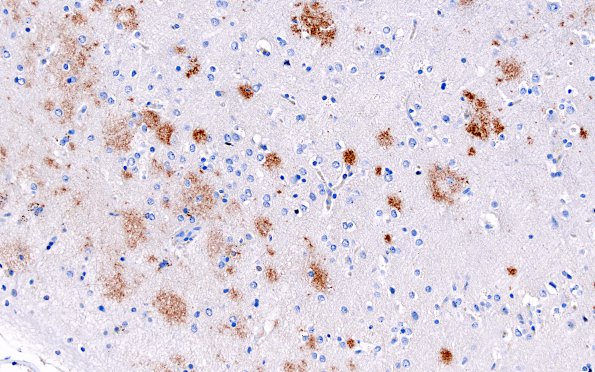 2B3 ABRA (Case 2) B-Amyloid 3