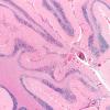 4A1 Amyloid B-related angiitis (ABRA) (CANP 2006-Case 5) H&E 2X