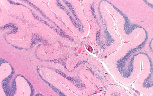 4A1 Amyloid B-related angiitis (ABRA) (CANP 2006-Case 5) H&E 2X