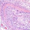 4A10 Amyloid B-related angiitis (ABRA) (CANP 2006-Case 5) H&E 14