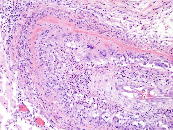 4A10 Amyloid B-related angiitis (ABRA) (CANP 2006-Case 5) H&E 14