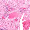 4A2 Amyloid B-related angiitis (ABRA) (CANP 2006-Case 5) H&E 10X