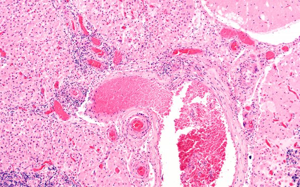 4A2 Amyloid B-related angiitis (ABRA) (CANP 2006-Case 5) H&E 10X