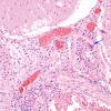 4A3 Amyloid B-related angiitis (ABRA) (CANP 2006-Case 5) H&E 7 copy