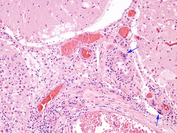 4A3 Amyloid B-related angiitis (ABRA) (CANP 2006-Case 5) H&E 7 copy