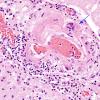 4A4 Amyloid B-related angiitis (ABRA) (CANP 2006-Case 5) H&E 6 copy