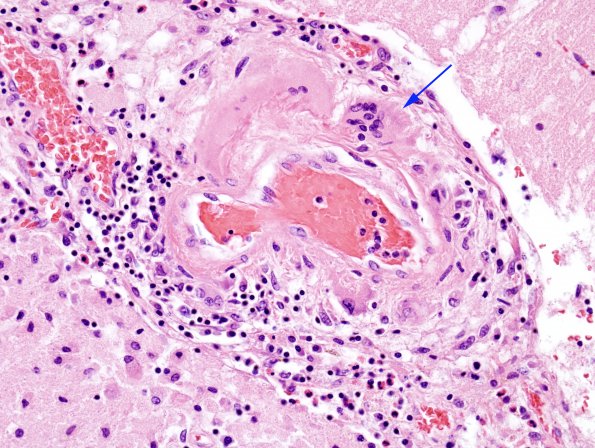 4A4 Amyloid B-related angiitis (ABRA) (CANP 2006-Case 5) H&E 6 copy