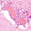 4A5  Amyloid B-related angiitis (ABRA) (CANP 2006-Case 5) H&E 8