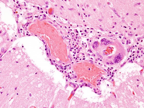 4A5  Amyloid B-related angiitis (ABRA) (CANP 2006-Case 5) H&E 8