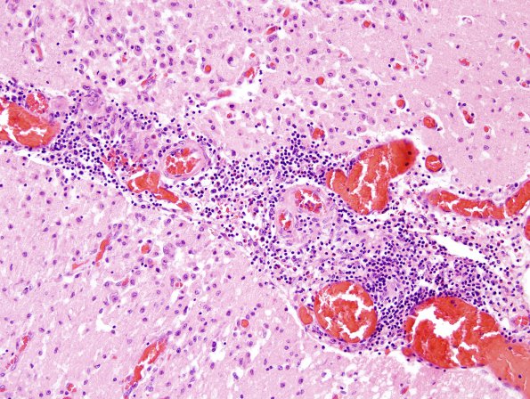 4A6 Amyloid B-related angiitis (ABRA) (CANP 2006-Case 5) H&E 10