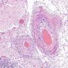 4A7 Amyloid B-related angiitis (ABRA) (CANP 2006-Case 5) H&E 12