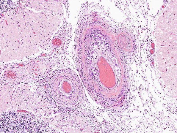 4A7 Amyloid B-related angiitis (ABRA) (CANP 2006-Case 5) H&E 12