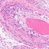 4A8 Amyloid B-related angiitis (ABRA) (CANP 2006-Case 5) H&E 20X 3