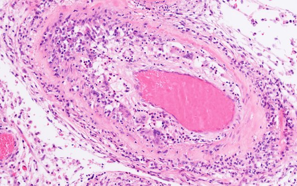 4A8 Amyloid B-related angiitis (ABRA) (CANP 2006-Case 5) H&E 20X 3