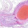 4A9 Amyloid B-related angiitis (ABRA) (CANP 2006-Case 5) H&E 13