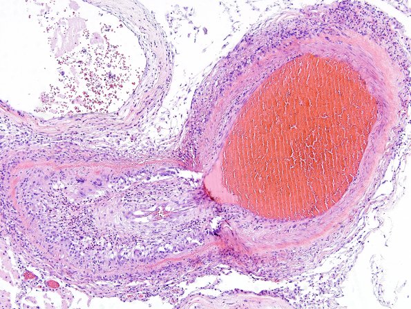 4A9 Amyloid B-related angiitis (ABRA) (CANP 2006-Case 5) H&E 13