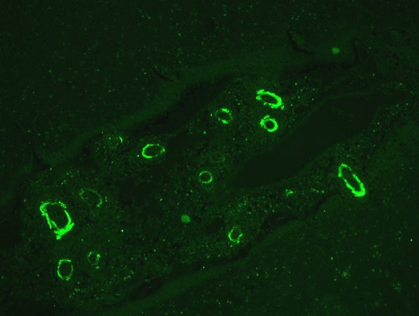 4B Amyloid B-related angiitis (ABRA) (CANP 2006-Case 5) Thio-S 2493