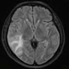 5A1 Amyloid B-related angiitis (ABRA) (Case 5) FLAIR - Copy