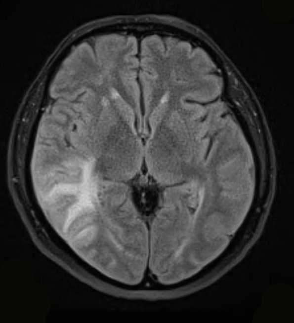 5A1 Amyloid B-related angiitis (ABRA) (Case 5) FLAIR - Copy