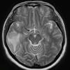 5A2 Amyloid B-related angiitis (ABRA) (Case 5) T2 W 1 - Copy (2)