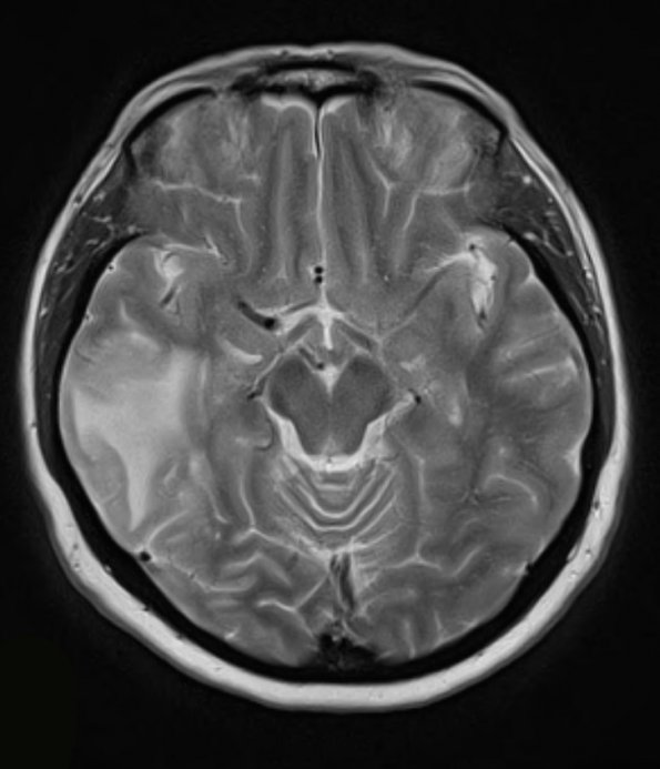 5A2 Amyloid B-related angiitis (ABRA) (Case 5) T2 W 1 - Copy (2)