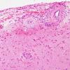 5B1 Amyloid B-related angiitis (ABRA) (Case 5) H&E 8