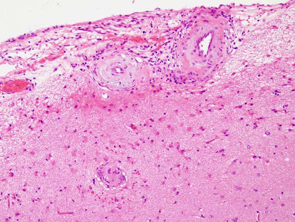 5B1 Amyloid B-related angiitis (ABRA) (Case 5) H&E 8