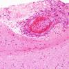 5B2 Amyloid B-related angiitis (ABRA) (Case 5) H&E 10