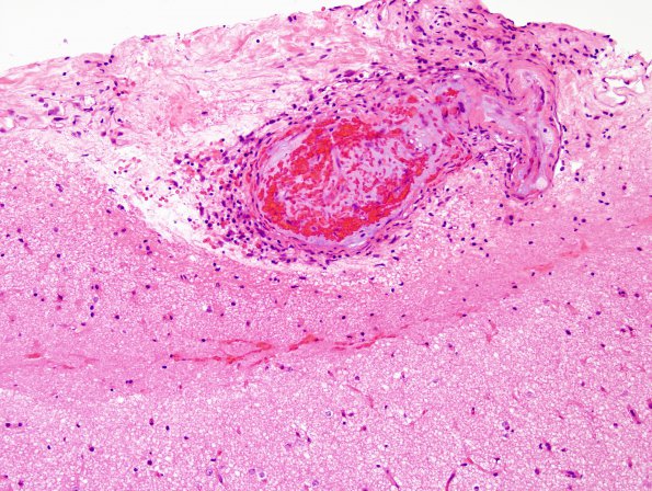 5B2 Amyloid B-related angiitis (ABRA) (Case 5) H&E 10