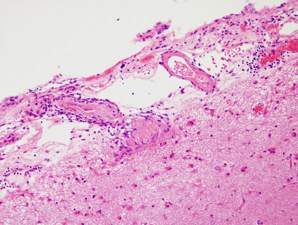 5B3 Amyloid B-related angiitis (ABRA) (Case 5) H&E 7