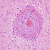 5B4 Amyloid B-related angiitis (ABRA) (Case 5) H&E 5