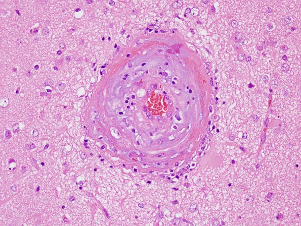 5B4 Amyloid B-related angiitis (ABRA) (Case 5) H&E 5