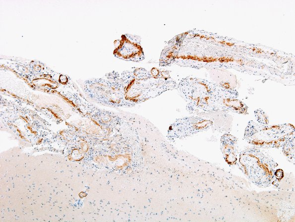 5C1 Amyloid B-related angiitis (ABRA) (Case 5) bAmyloid IHC 3