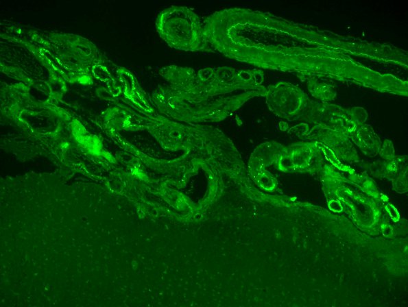 5C2 Amyloid B-related angiitis (ABRA, (Case 5) bAmyloid Thioflavin-S 9