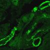 5C3 Amyloid B-related angiitis (ABRA, (Case 5) bAmyloid Thioflavin-S 11