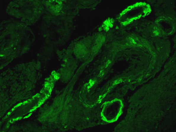 5C3 Amyloid B-related angiitis (ABRA, (Case 5) bAmyloid Thioflavin-S 11