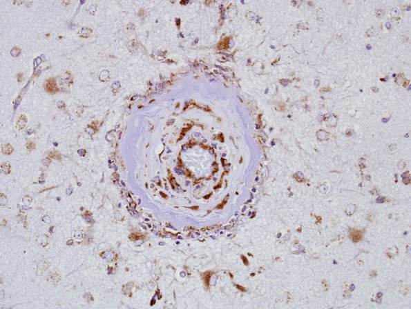 5D2 Amyloid B-related angiitis (ABRA) (Case 5) SAA 3